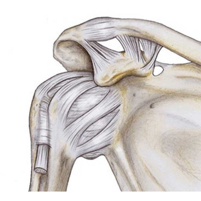 Traitement de l’arthropathie acromio-claviculaire à Versailles - Chirurgie de l'épaule, du coude ...