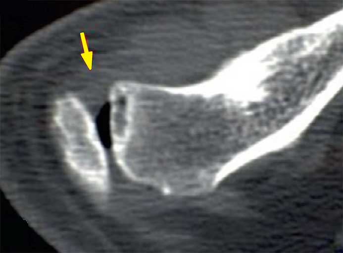 Scanner arthrose acromio-claviculaire
